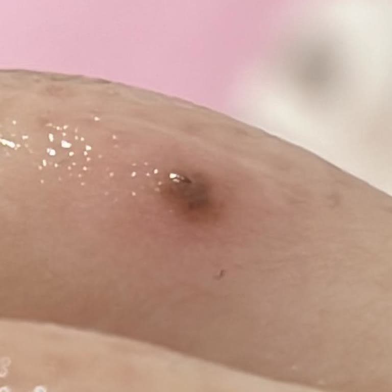 As Estetik (İstanbul) Lazer Epilasyon Seanslarında Sürekli Yanık Ve İlgisizlik!