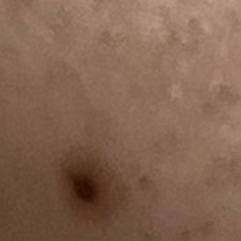 As Estetik (İstanbul) Lazer Epilasyon Seanslarında Sürekli Yanık Ve İlgisizlik!