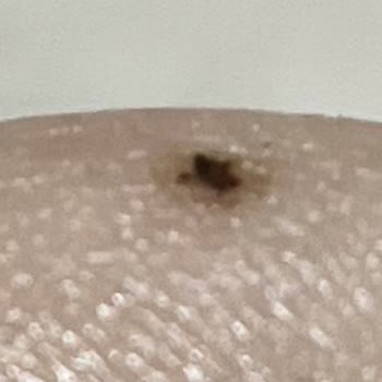 As Estetik (İstanbul) Lazer Epilasyon Seanslarında Sürekli Yanık Ve İlgisizlik!