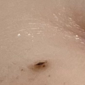 As Estetik (İstanbul) Lazer Epilasyon Seanslarında Sürekli Yanık Ve İlgisizlik!