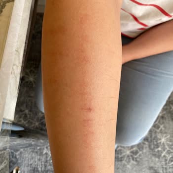 Lazer Epilasyon Sonrası Kolumda Yanık Oluştu, İlgisiz Davranışla Karşılaştım