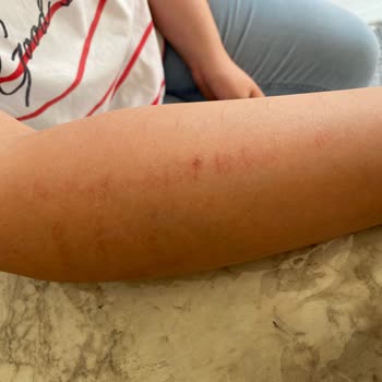 Lazer Epilasyon Sonrası Kolumda Yanık Oluştu, İlgisiz Davranışla Karşılaştım