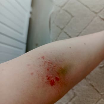 Veet Tüy Dökücü Krem Ciltte Kabarma Ve Soyulmaya Neden Oldu