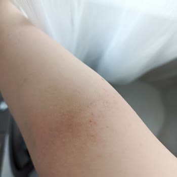 Veet Tüy Dökücü Krem Ciltte Kabarma Ve Soyulmaya Neden Oldu