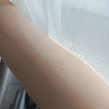 Veet Tüy Dökücü Krem Ciltte Kabarma Ve Soyulmaya Neden Oldu