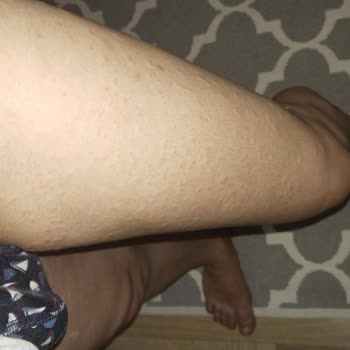 Veet Men Ürünü Cildimde Ciddi Sorunlara Yol Açtı