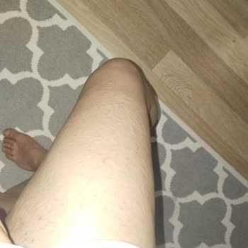 Veet Men Ürünü Cildimde Ciddi Sorunlara Yol Açtı