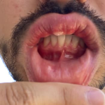 Diş Beyazlatma İşleminde Yaşanan İhmal Sonucu Ağız İçi Yanık Sorunu