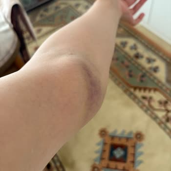 Kan Alımı Sonrası Kolumda Geçmeyen Şişlik Ve Morarma