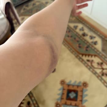 Kan Alımı Sonrası Kolumda Geçmeyen Şişlik Ve Morarma