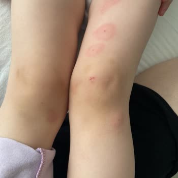 Çocuğum İçin Aldığım Krem İşe Yaramadı