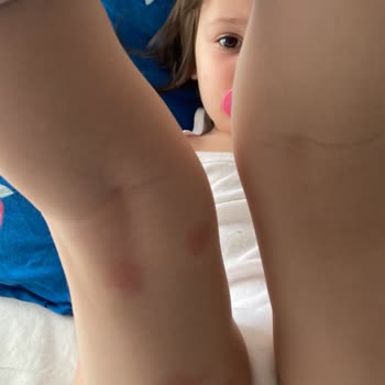 Çocuğum İçin Aldığım Krem İşe Yaramadı