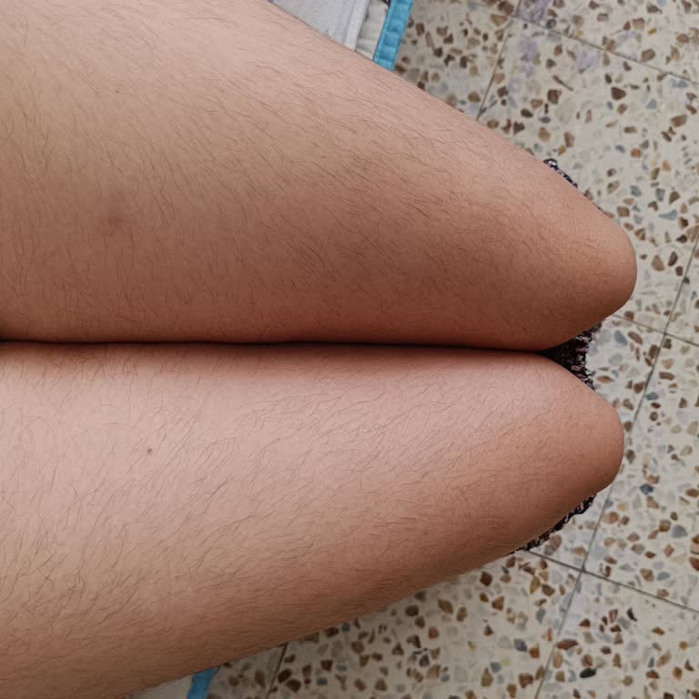 Lazer Epilasyon Sonuçsuz Kaldı, Mağduriyetim Giderilmiyor