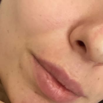 Uzm. Dr. Kenan Keskin Burun Dolgusu Yaptırdım Burun Ucundaki Kızarıklık Geçmedi