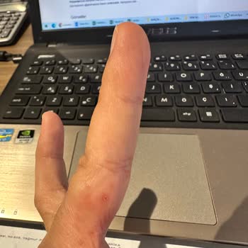 Zen Pırlanta Yüzükte Tekrarlayan Alerji Ve Çözüm Bulamama Deneyimi