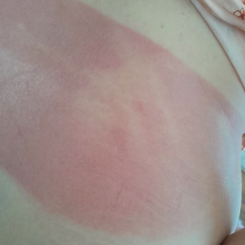 Arko Sun Care 50 Faktör Krem Cildimizi Koruyamadı, Kızarıklık Ve Yanık Oluştu