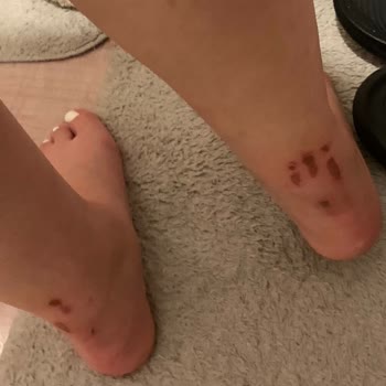 Deichmann İki Saatlik Kullanımda Ayaklarımda Kalıcı Yaralar Oluştu
