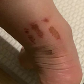 Deichmann İki Saatlik Kullanımda Ayaklarımda Kalıcı Yaralar Oluştu