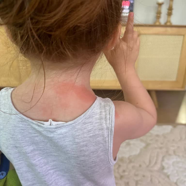 Mustela Güneş Kremi Çocuğumda Yanıklara Sebep Oldu