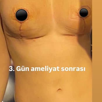 Yanlış Protez Seçimi Ve Yetersiz Destek Sonrası Hayal Kırıklığı