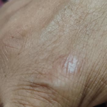 Cam Ocak Patladı, Yaralanma Tehlikesi Yaşadık