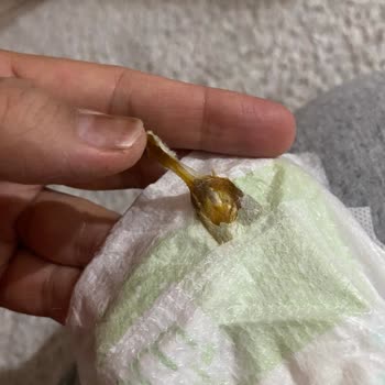 Bebek Bezinde Yabancı Cisim Şoku: Sağlık Riski!