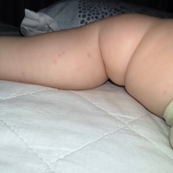 Alerji İçin Aldığım Ürün Oğlumda Ciddi Reaksiyona Yol Açtı