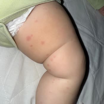 Alerji İçin Aldığım Ürün Oğlumda Ciddi Reaksiyona Yol Açtı