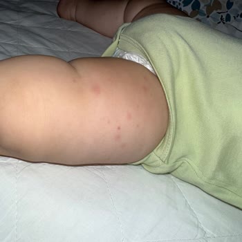 Alerji İçin Aldığım Ürün Oğlumda Ciddi Reaksiyona Yol Açtı