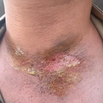 Agiss Tüy Dökücü Krem Cildimde Yanıklara Sebep Oldu