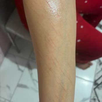 Lazer Epilasyon Sonrası Ciltte Yanık Ve İz Problemi