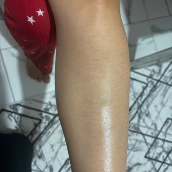 Lazer Epilasyon Sonrası Ciltte Yanık Ve İz Problemi