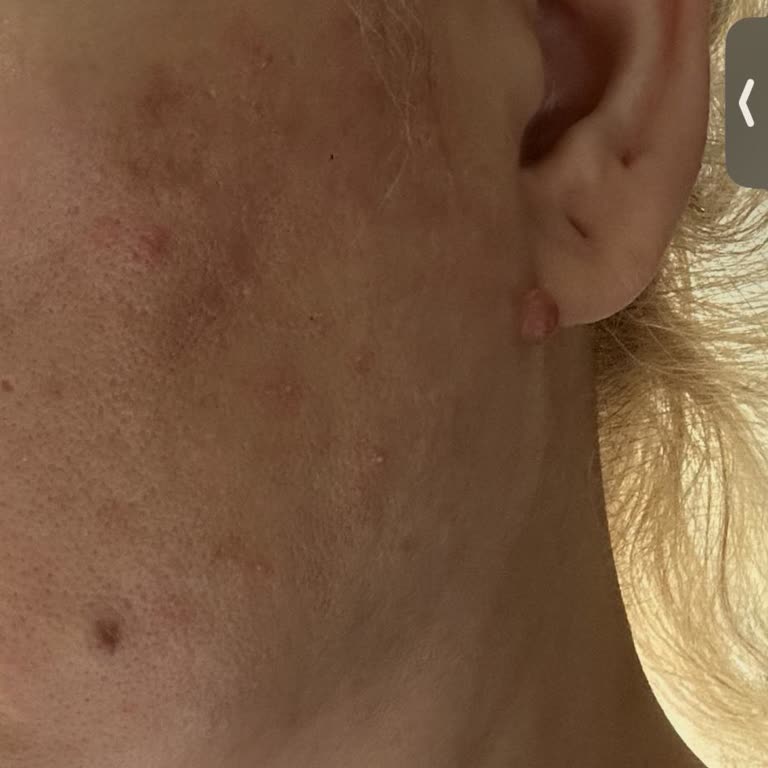 I Used L'Oréal Vitamin C Serum and It Oxidized, Causing Redness and Breakouts