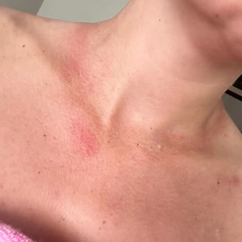 Çelik Ürün Ciddi Alerji Yaptı, Mağaza Yardımcı Olmadı