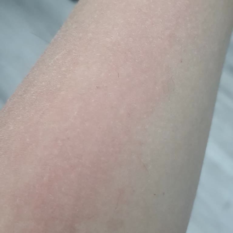 Mustela Güneş Kremi Ve Nemlendirici Ciltte Yanık Ve Reaksiyona Sebep Oldu