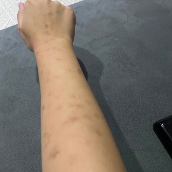 Dr. Zehra Tacizer Kılınç Lazer Pişmanlığı