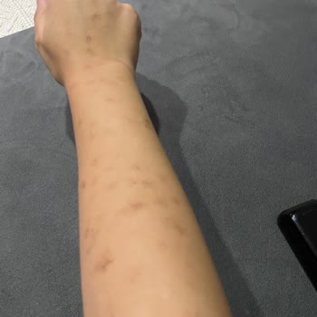 Lazer Epilasyon Sonrası Mağduriyet Ve Yetersiz Hizmet