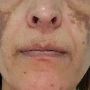 Gülçin Yeni Beauty Yüzüm Toplum İçine Çıkılamaz Hale Geldi