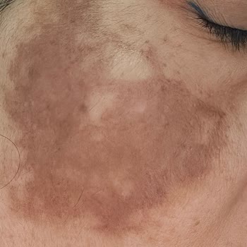 Gülçin Yeni Beauty Yüzüm Toplum İçine Çıkılamaz Hale Geldi