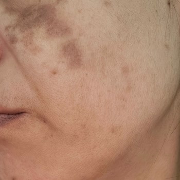 Gülçin Yeni Beauty Yüzüm Toplum İçine Çıkılamaz Hale Geldi