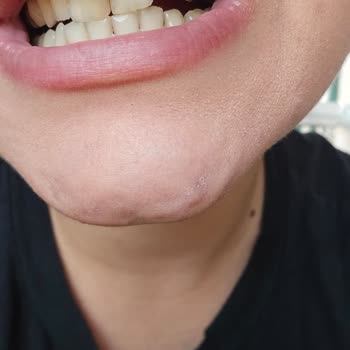 Şehit Mehmet Kılınç Adsh Dolgum Kısa Sürede Kırıldı, Seyahatimi İptal Ettim