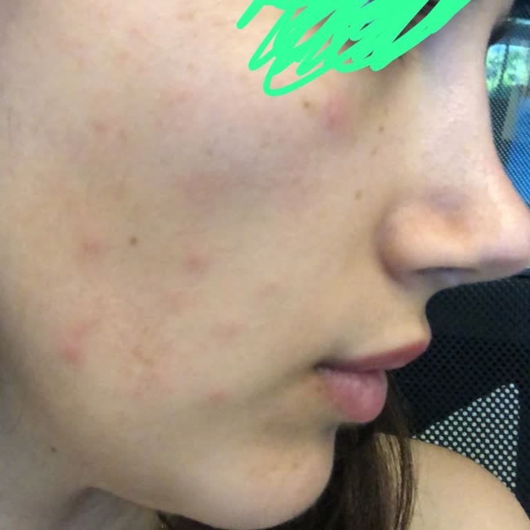 Flormar Fondöten Cildimde Sivilce Ve Yağlanmaya Yol Açtı, Hayal Kırıklığı Yaşadım