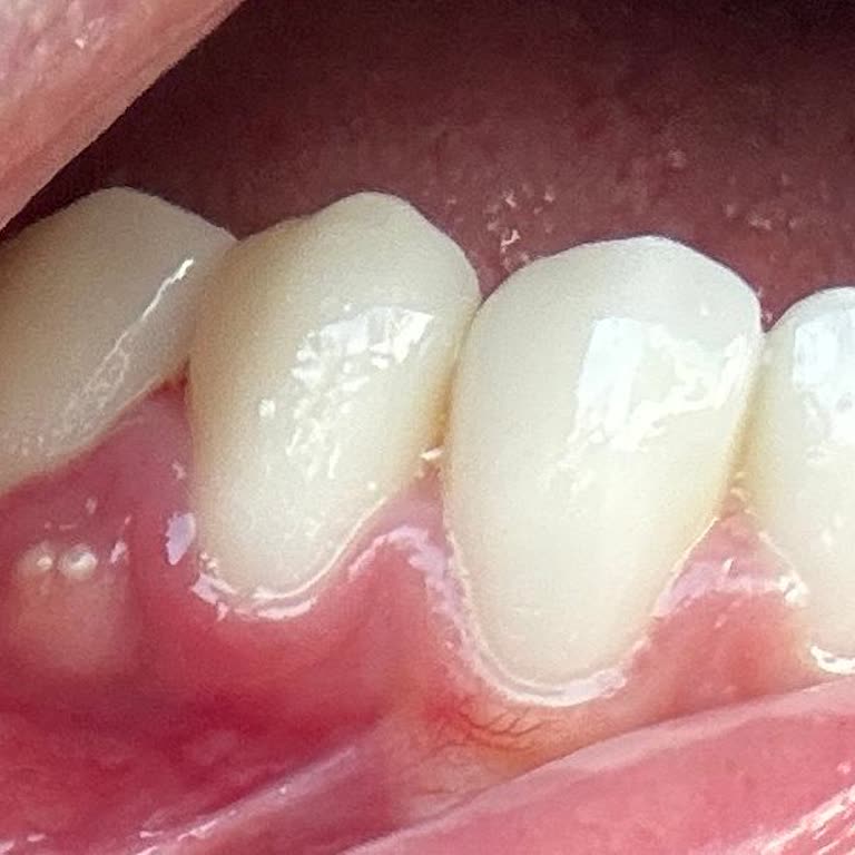 Zirkonyum Diş Tedavisinde Mağduriyet Ve İlgisizlik