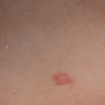 Kullanım Talimatlarına Rağmen İpl Cihazı Yanık Oluşturdu İade Reddedildi