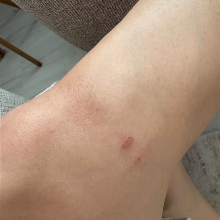 Kullanım Talimatlarına Rağmen İpl Cihazı Yanık Oluşturdu İade Reddedildi