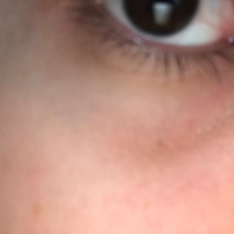 Gözaltı Kremi Cildimi Tahriş Etti, Para İadem Yapılmıyor