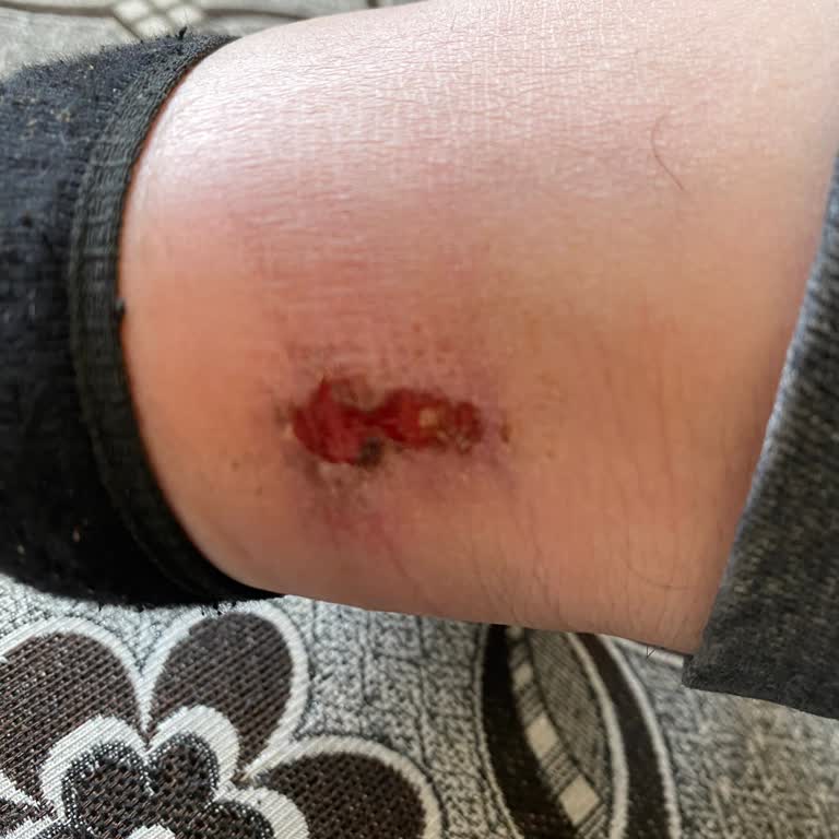 İnci Ayakkabı Aldığım Ayakkabı Bir Günde Ayağımı Yara Yaptı