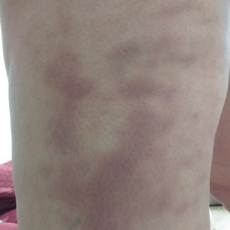 Derman Uysal Beauty G5 İşlemi Sonrası Bacaklarımda Şiddetli Morluklar ve Ücret İadesi Sorunu