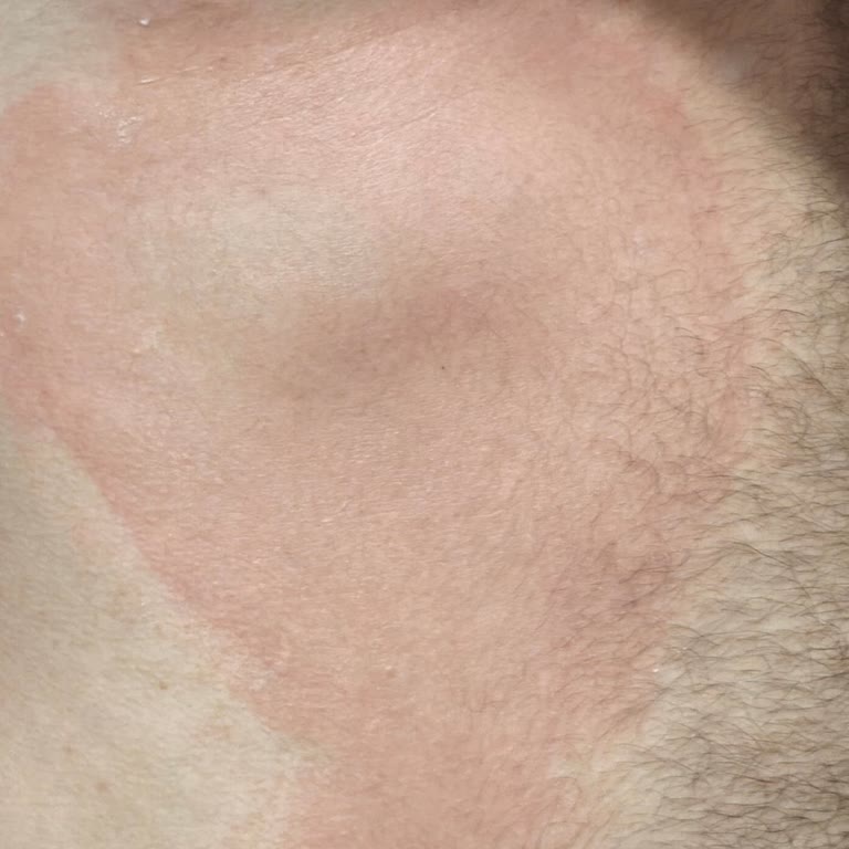 Thermoflex Sonrası Kaşıntı Ve Kızarıklık Yaşadım