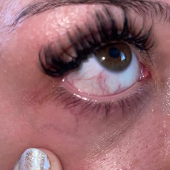 Yanlış Kirpik Uygulaması Sonrası Gözlerimde Şiddetli Yanma Ve Batma